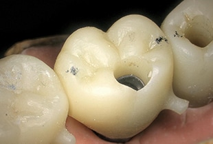Observation d'implants dentaires